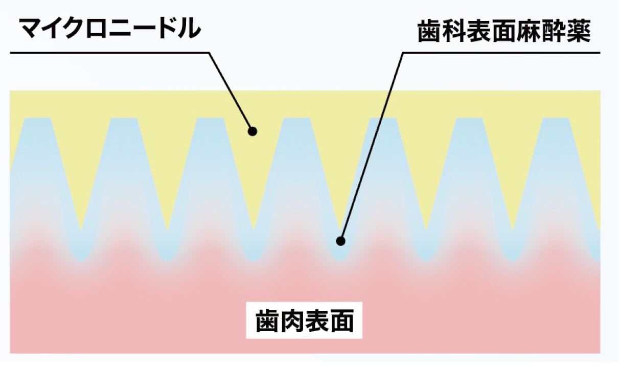 アネスパッチのメカニズム