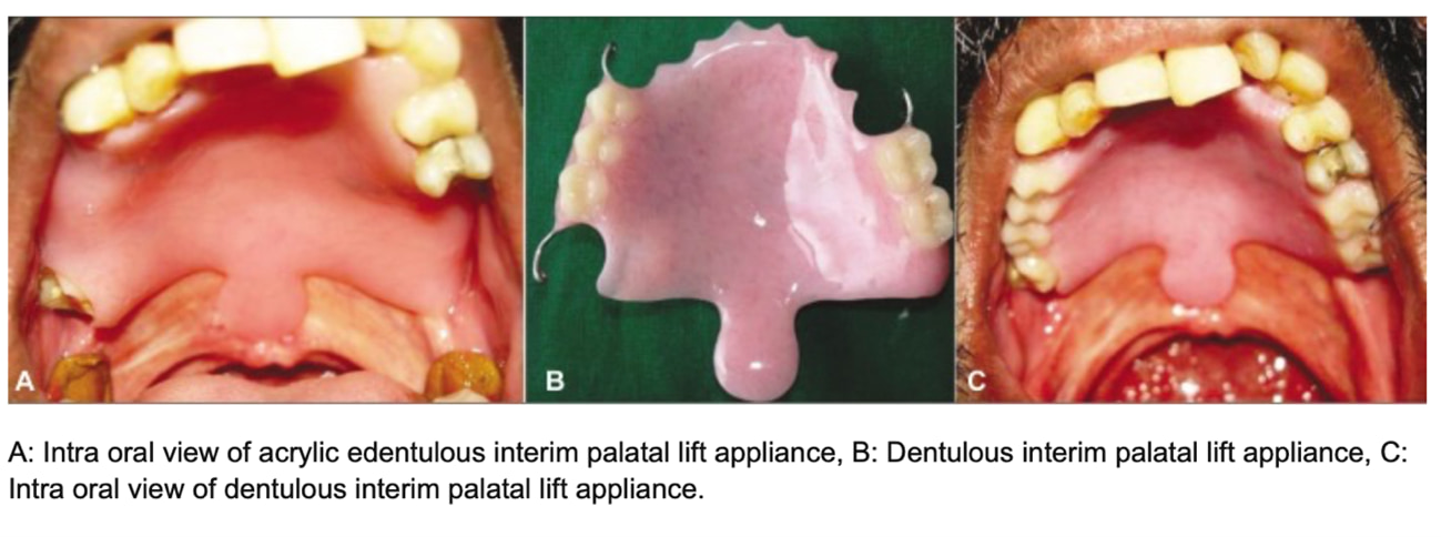 画像出典：Raj, N., Raj, V., & Aeran, H. (2012). Interim palatal lift prosthesis as a constituent of multidisciplinary approach in the treatment of velopharyngeal incompetence. The journal of advanced prosthodontics, 4(4), 243-247.