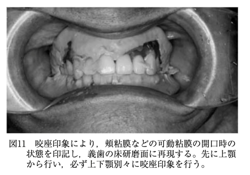 画像出典：矢﨑秀昭(2011) 義歯による口腔組織及び機能の保全
