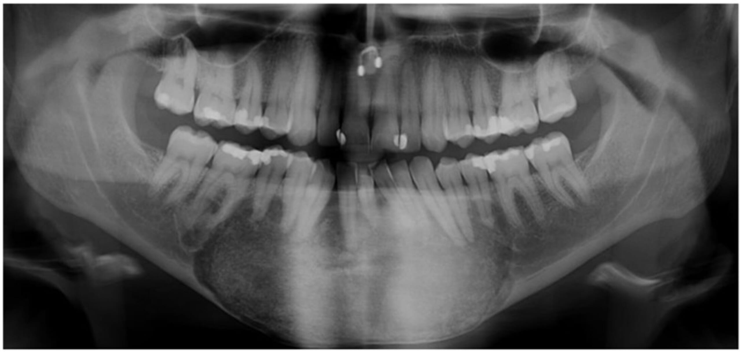 画像引用元:Obermeier, K. T., Hartung, J. T., Hildebrandt, T., Dewenter, I., Smolka, W., Hesse, E., ... & Abdullah, A. (2023). Fibrous dysplasia of the jaw: advances in imaging and treatment. Journal of Clinical Medicine, 12(12), 4100.