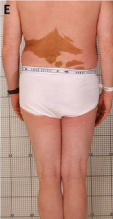 画像引用元:Collins, M. T., Singer, F. R., & Eugster, E. (2012). McCune-Albright syndrome and the extraskeletal manifestations of fibrous dysplasia. Orphanet journal of rare diseases, 7(Suppl 1), S4.