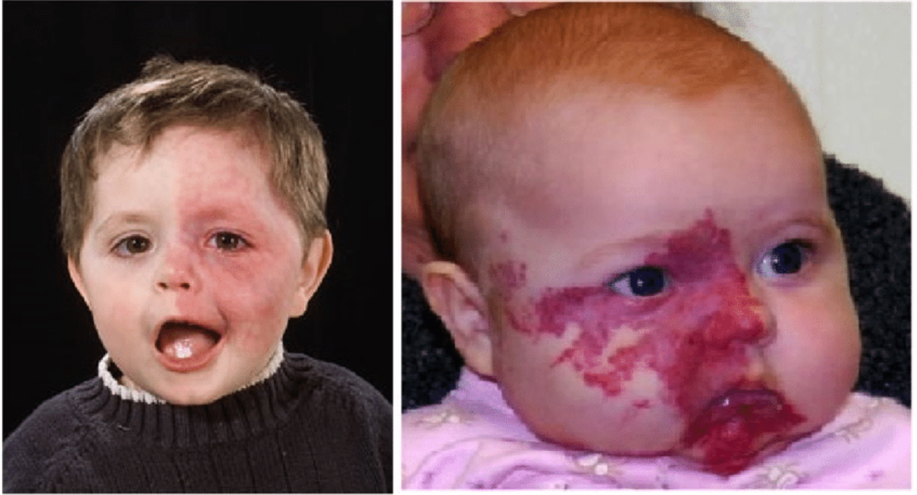 画像引用元:Asadi, S. (2020). The role of genetic mutations in gene GNAQ in Sturge-Weber syndrome. J Cell Signal Damage Assoc Mol Patterns, 1, 15-19.