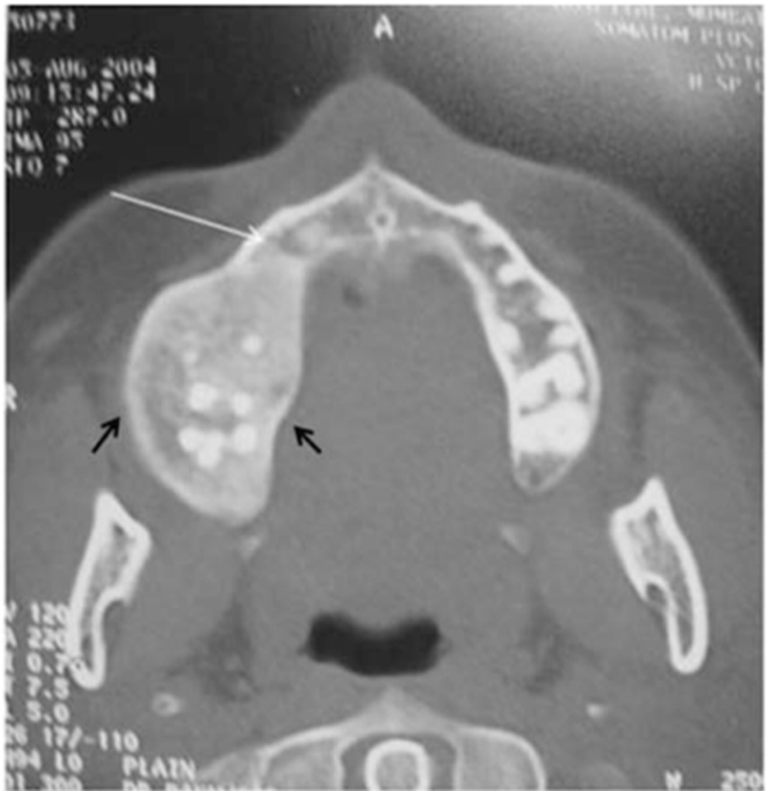 CT画像引用元:Sontakke, S. A., Karjodkar, F. R., & Umarji, H. R. (2011). Computed tomographic features of fibrous dysplasia of maxillofacial region. Imaging science in dentistry, 41(1), 23-28.