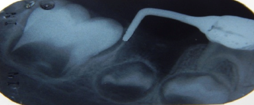 写真引用元：[1]DP, S. K., BHATT, R., BHATT, K., & PANDYA, P. (2015). Distal shoe space maintainer: A guide for the permanent first molar. Indo-European Journal of Dental Therapy and Research, 3(2), 284-286.